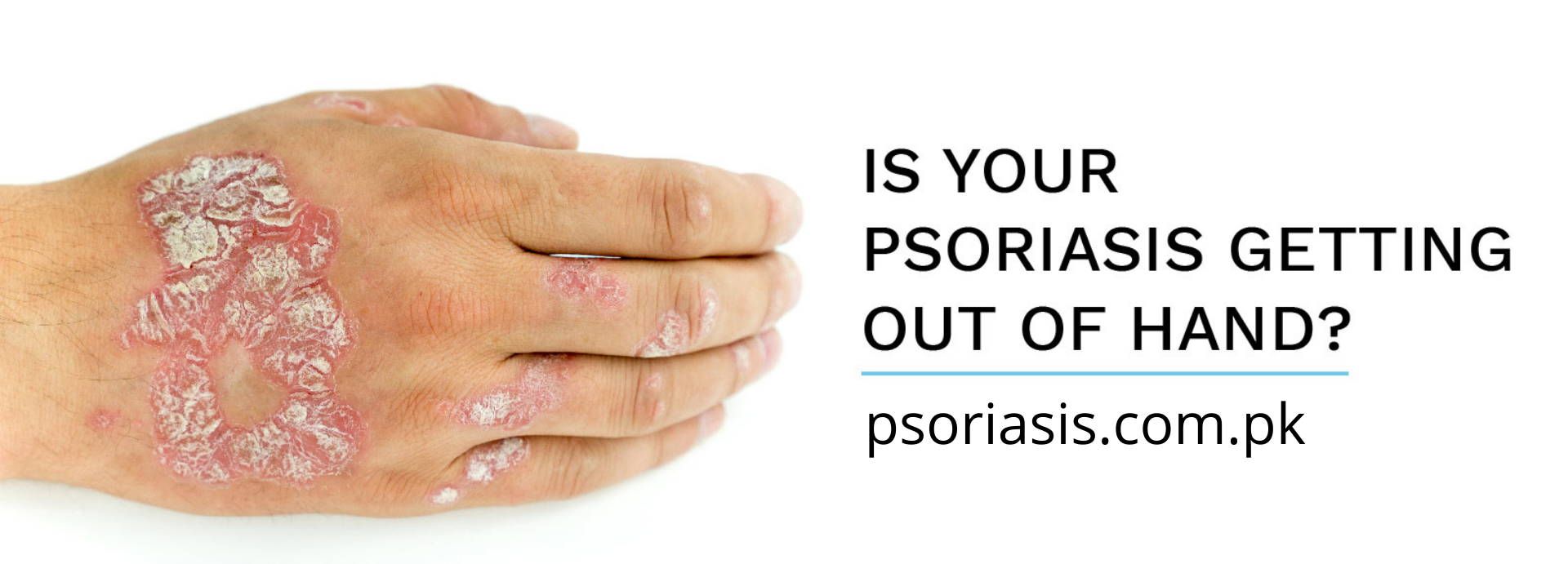 psoriasis.com_.pk_-e1642416266718.png