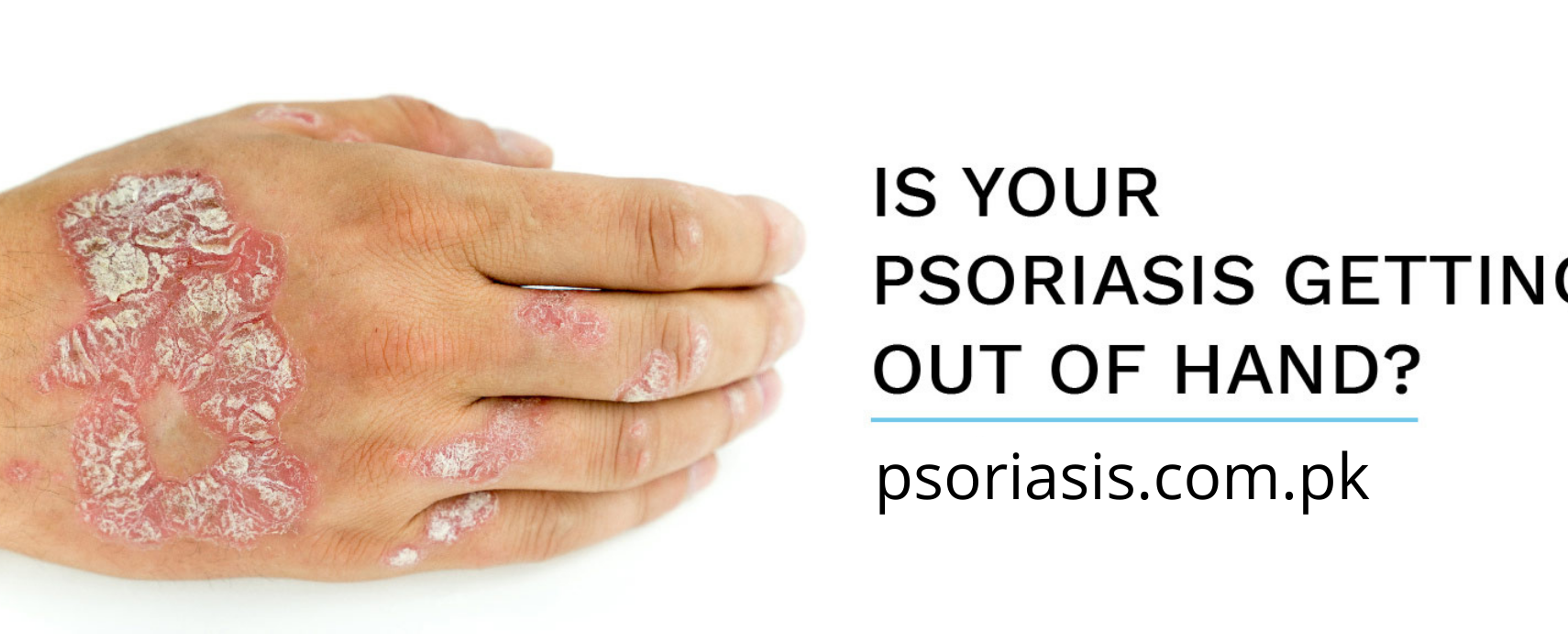 psoriasis.com_.pk_-e1642416266718.png